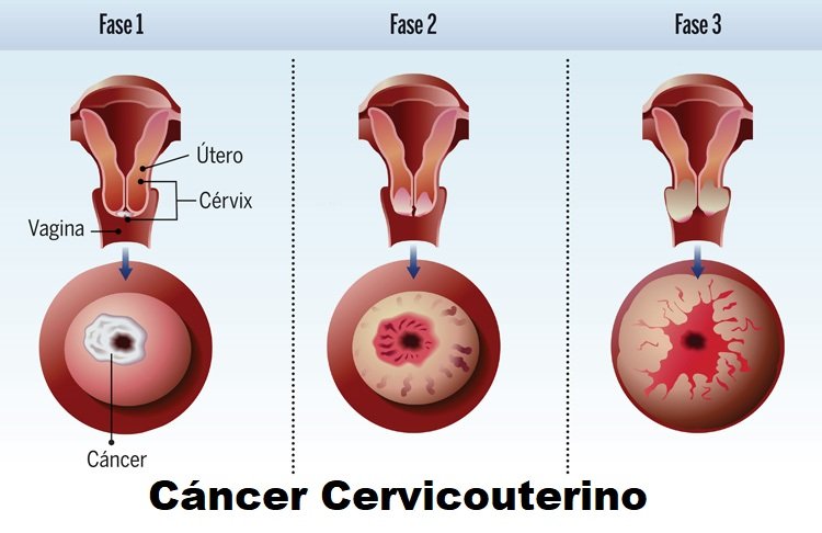 cáncer cervicouterino