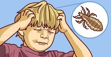 niño con piojos en la cabeza ilustración