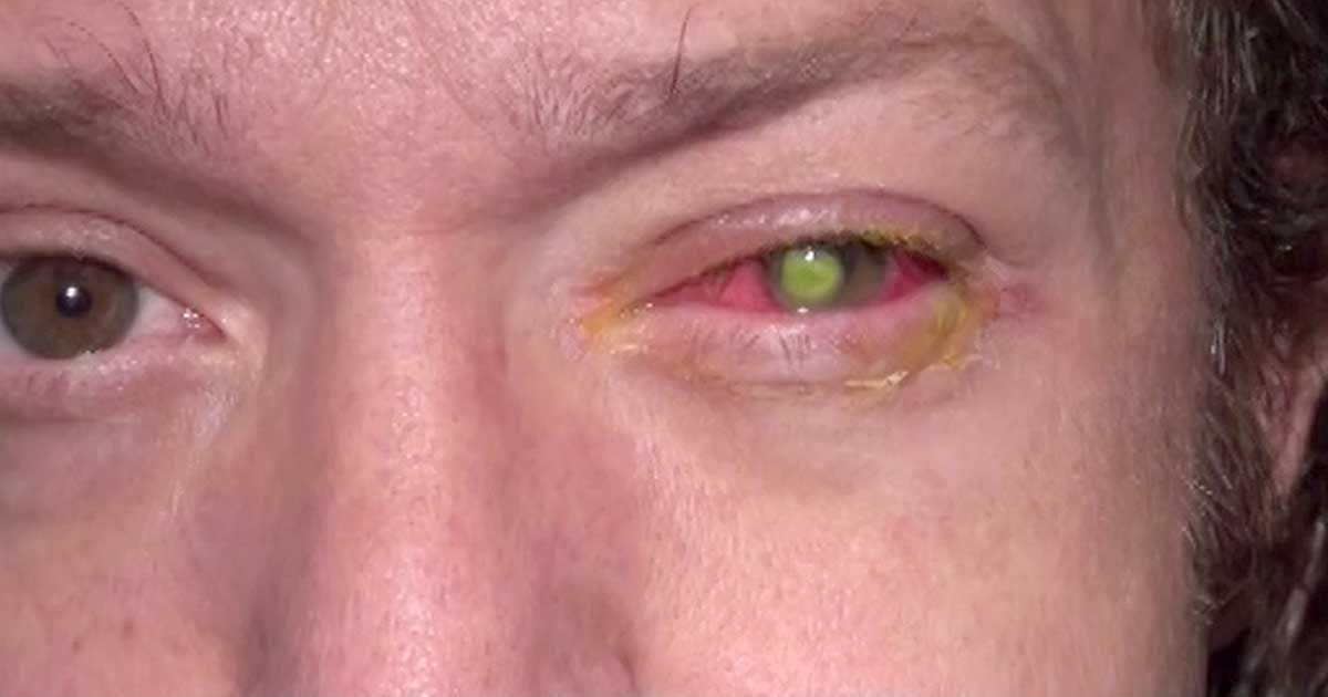 Los lentes de contacto le hicieron quedar ciego