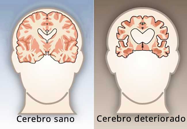 diferencia entre un cerebro sano y un cerebro deteriorado