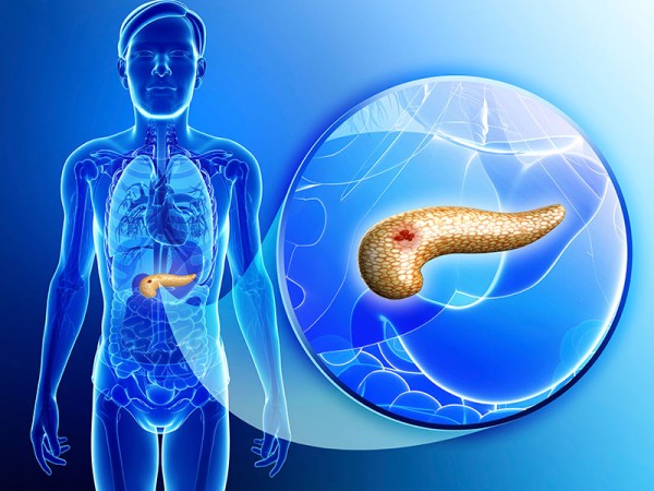 La diabetes tipo 2 puede ser causante del sobrepeso