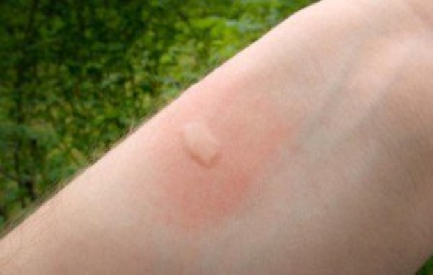 Mujer con picadura de mosquito en su brazo