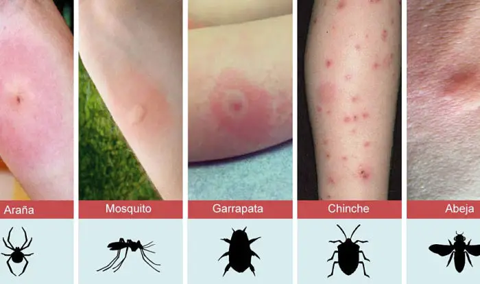 Descubre las picaduras de insectos más comunes