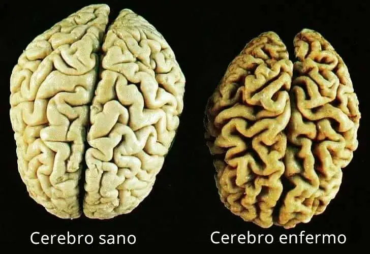 vitaminas que te ayudarán a prevenir el deterioro del cerebro