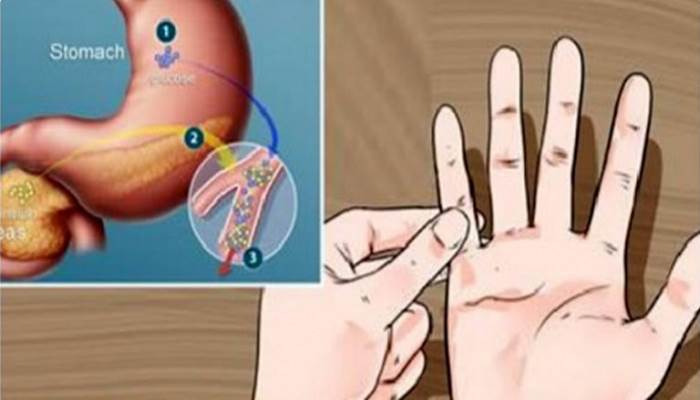 Prueba casera para detectar prediabetes