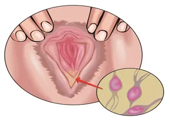 olor a pescado por Tricomoniasis