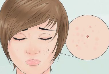 joven con un brote de acne