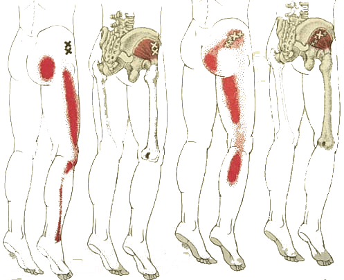 dolor de cadera por ciática