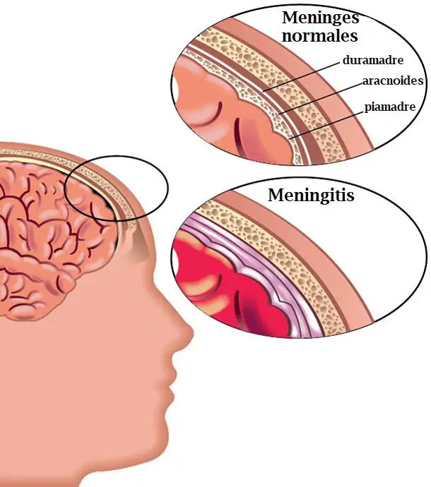 meningitis cerebro