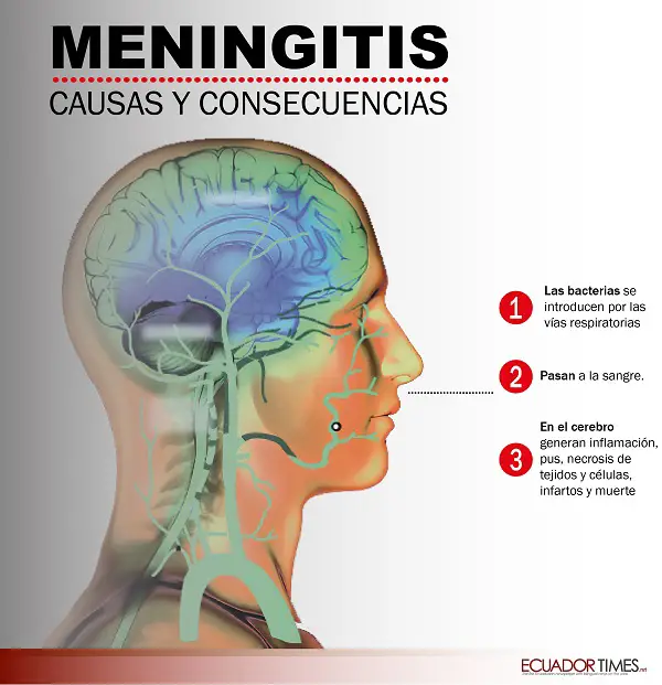 meningitis ilustración