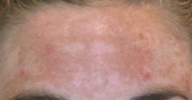 mujer con el rostro manchado