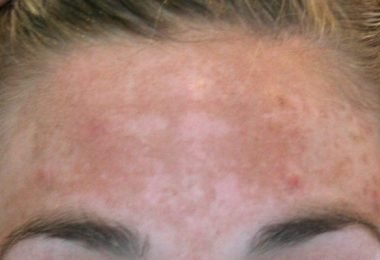 mujer con el rostro manchado