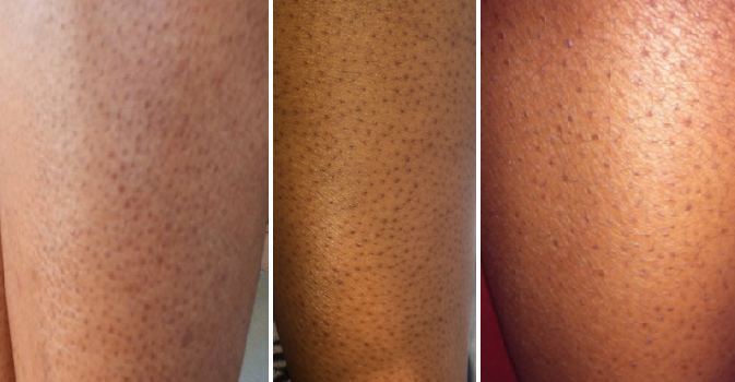 piernas de fresa causas