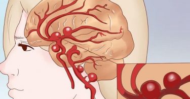 riesgo de padecer aneurisma por el endurecimiento de las arterias