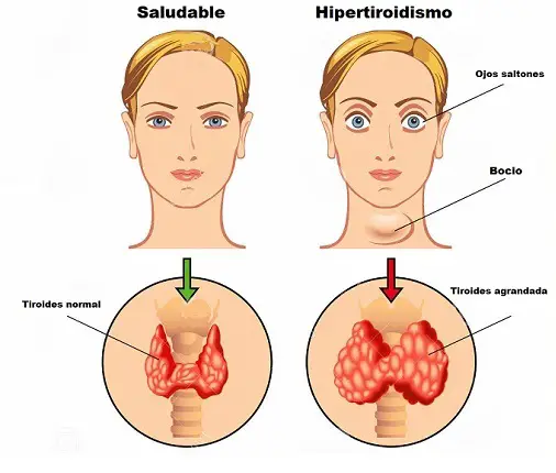 hormonas tiroideas enfermedades