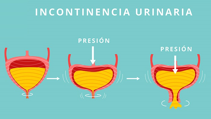 incontinencia urinaria en las mujeres