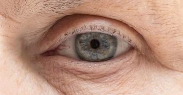 Una persona adulta que presenta un derrame ocular