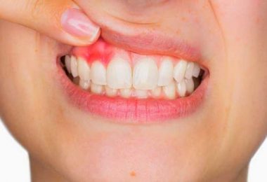 encías inflamadas en una mujer