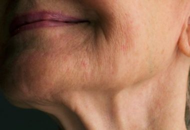 una mujer con arrugas que usa colágeno hidrolizado