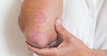 Manifestaciones en la piel de la artritis psoriásica