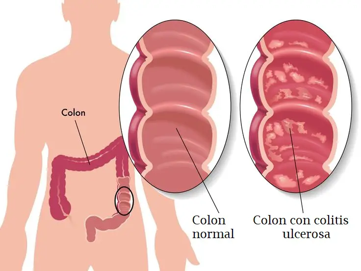 colitis ulcerosa