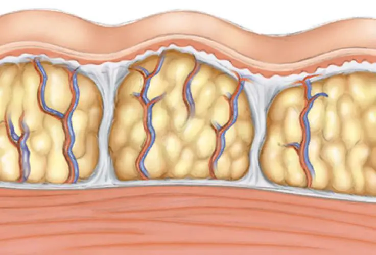 grasa localizada en el cuerpo