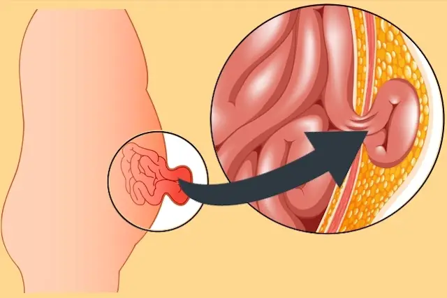 Distinguiendo una hernia de un desgarro abdominal
