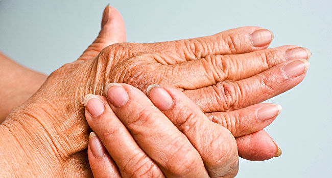 La evolución de los síntomas de la artritis psoríasica