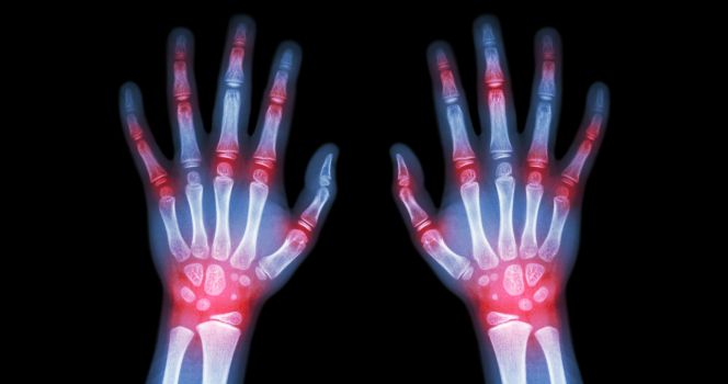 las causas de la artritis reumatoide