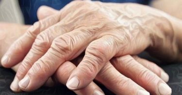 Mujer que padece artritis reumatoide y tiene los dedos de la mano deformados
