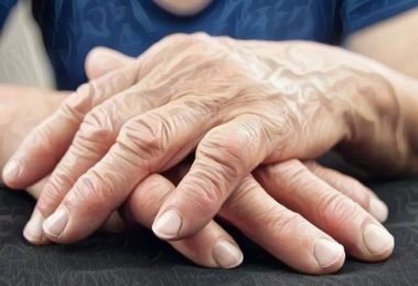 Mujer que padece artritis reumatoide y tiene los dedos de la mano deformados