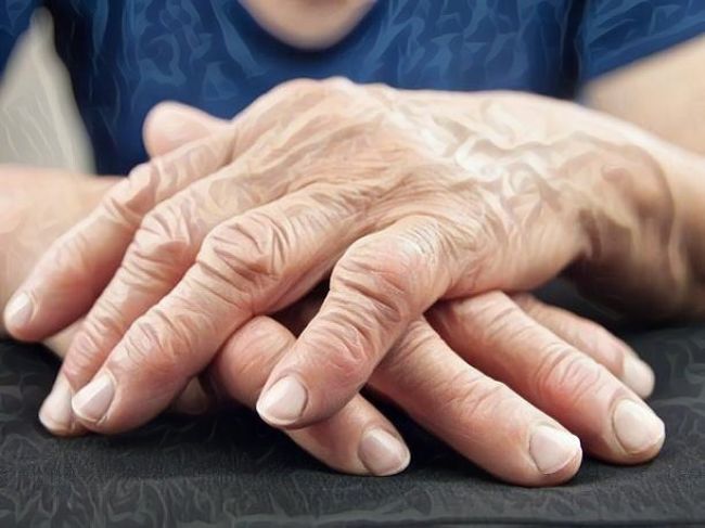 Mujer que padece artritis reumatoide y tiene los dedos de la mano deformados