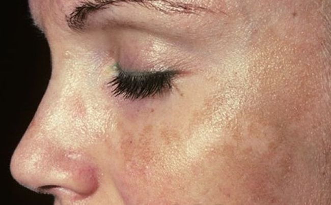 Mujer joven que presenta el la máscara del embarazo o melasma