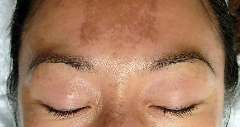 melasma