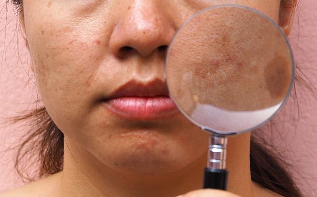 mujer con paño en la cara y problemas de melasma en la piel del rostro