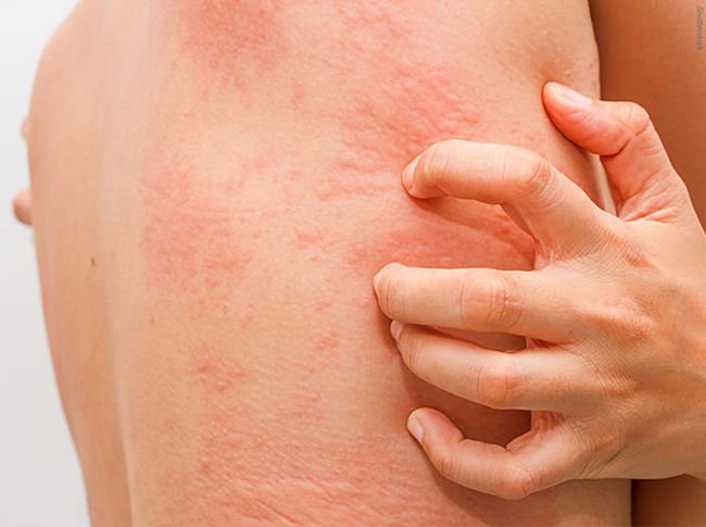 síntomas de la urticaria en el cuerpo