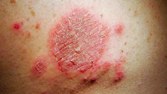 Manifestación de las alergias en la piel