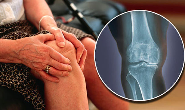 Mujer con dolores en las rodillas por osteoartrosis de rodilla