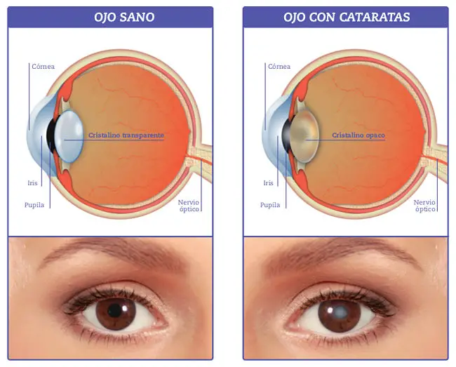 cómo se ve un ojo sano vs un ojo que presenta síntomas de cataratas
