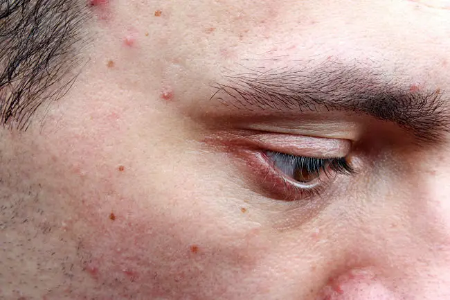 Las causas de la foliculitis y cómo se puede tratar