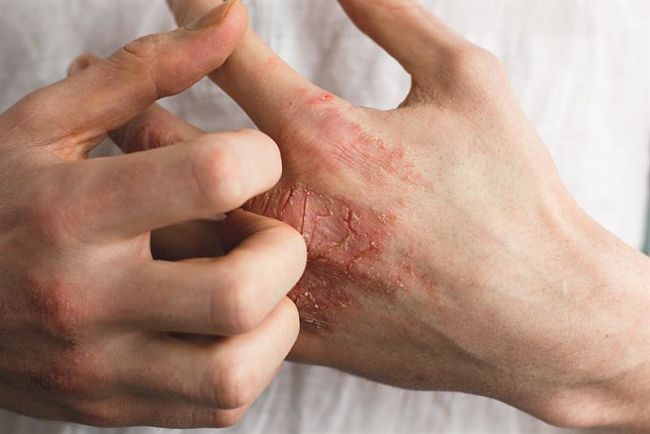 Cómo se ve la dermatitis en las manos