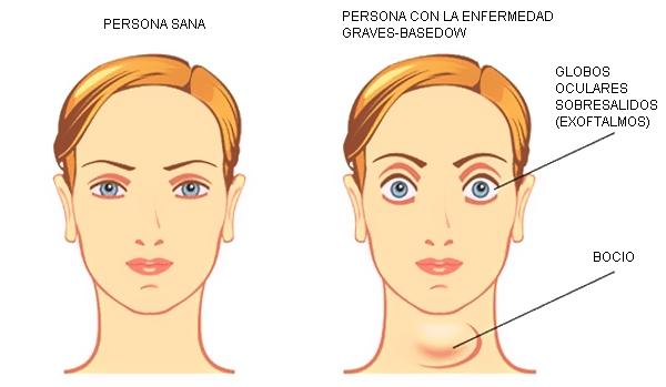 Síntomas de la enfermedad de graves y el hipertiroidismo