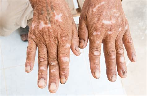 signos de esclerodermia en las manos
