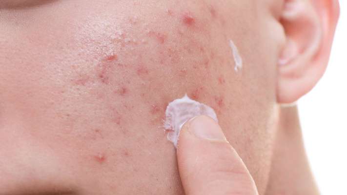 Los diferentes tipos de infecciones de la piel y cómo pueden ser tratados naturalmente