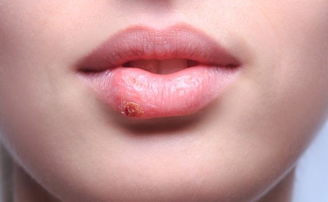 Labios inflamados y la presencia de herpes