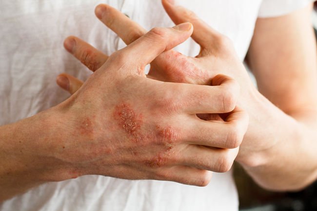 Una persona rascando sus manos con presencia de llagas y enrojecimiento por padecimiento de dermatitis atópica