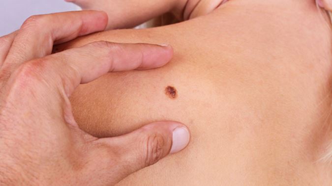 Presencia de cáncer en la piel como el melanoma