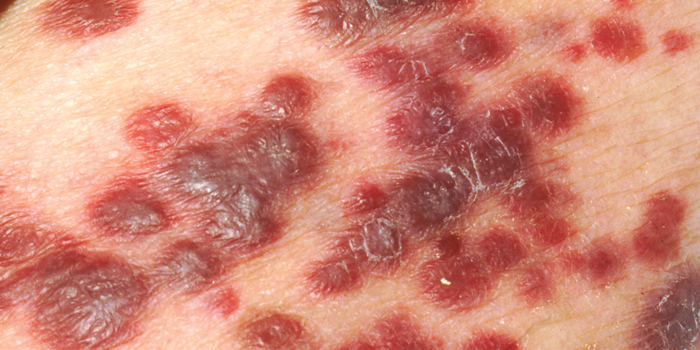Manifestación del melanoma en la piel