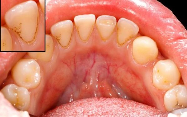 Los síntomas de piorrea o periodontitis