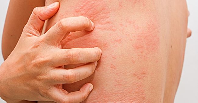 Reacciones adversas por el consumo de antibióticos